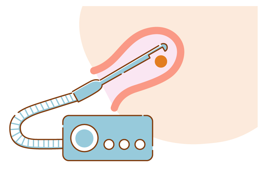 EVA法（電動吸引法）