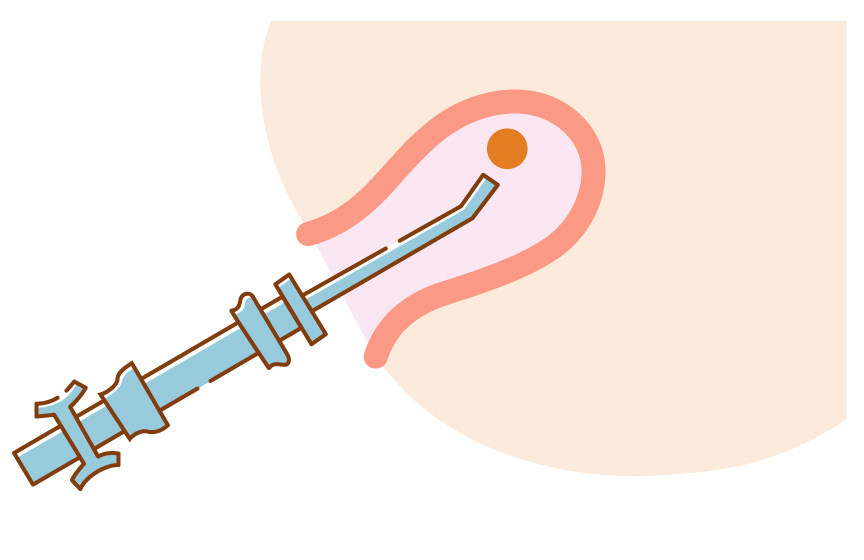 MVA法（手動吸引法）