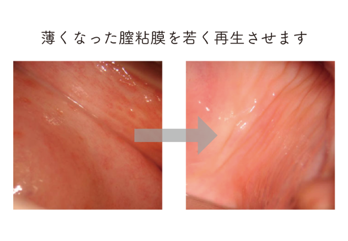 潤いある膣粘膜に